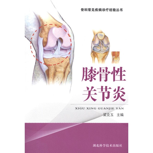 《膝骨性关节炎》中全膝关节置换术由湖北省中山医院