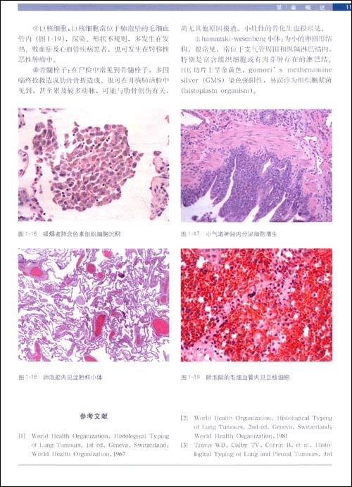 根据流行病学特点,和临床表现分为普通感冒,咽炎和支气管炎